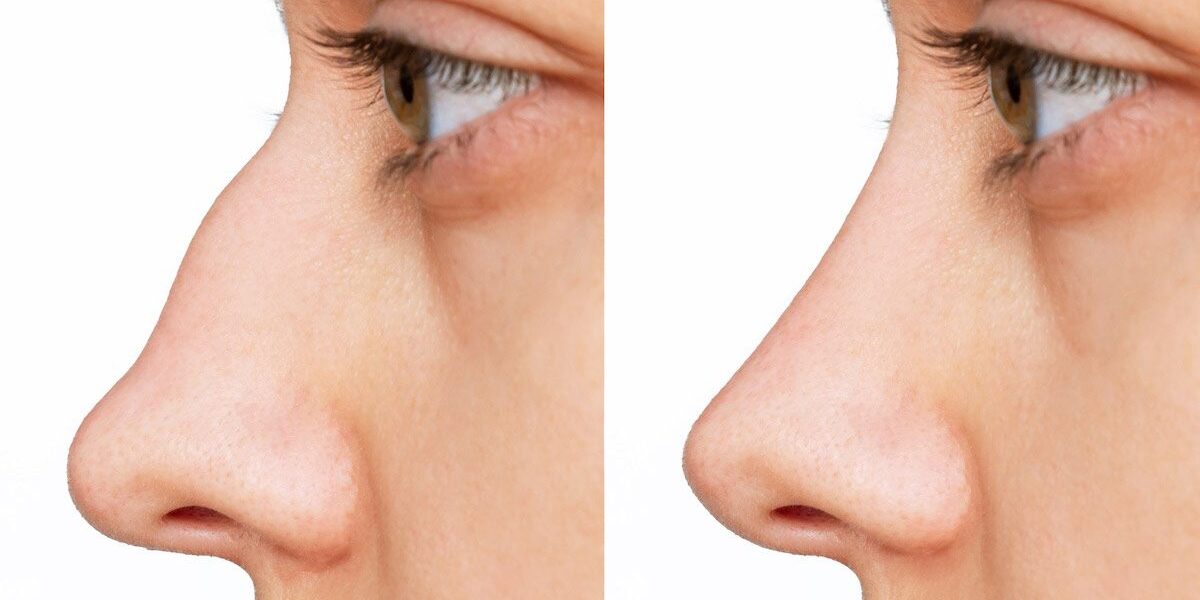 profile-womans-face-nose-before-after ภาพผู้หญิงหันข้าง ก่อนและหลังทำการตอกฐานจมูก