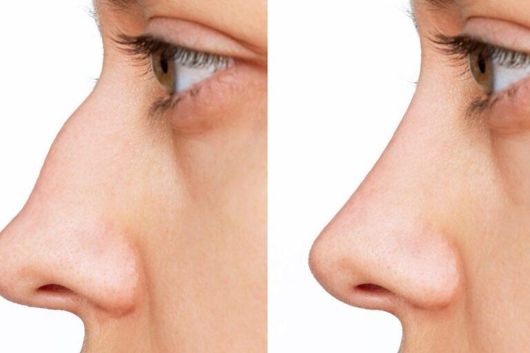 ภาพผู้หญิงหันข้าง ก่อนและหลังทำการตอกฐานจมูก