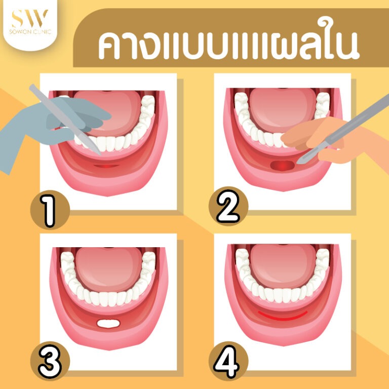 เสริมคางแผลใน