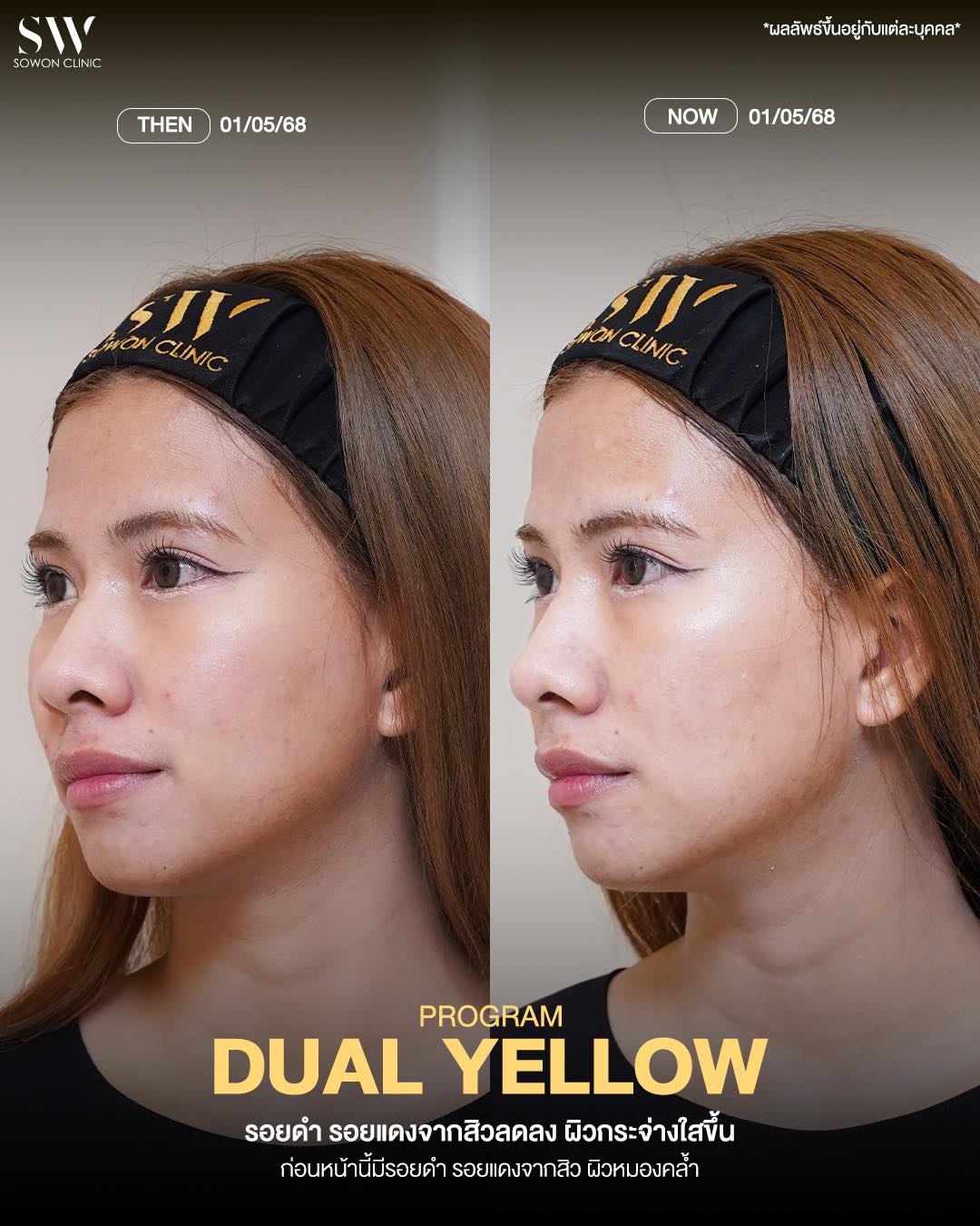Dual Yellow 03