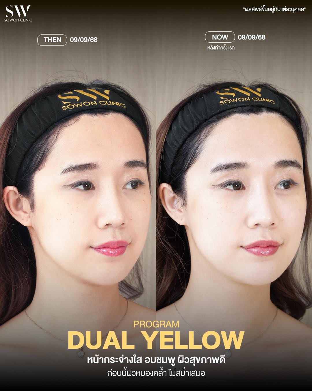 Dual Yellow 04