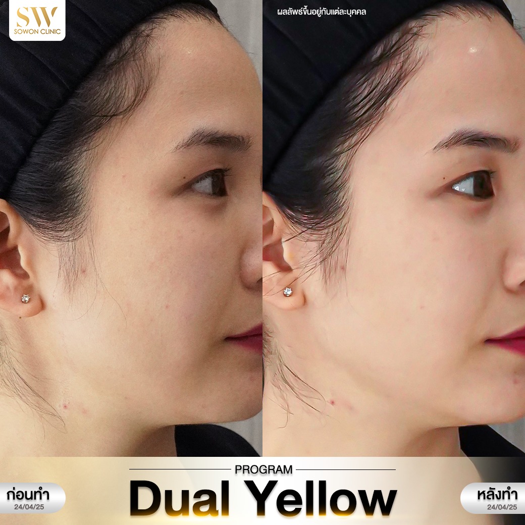 เลเซอร์หน้าใส รีวิว03