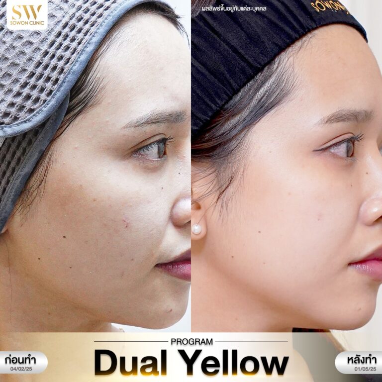 เลเซอร์หน้าใส รีวิว01