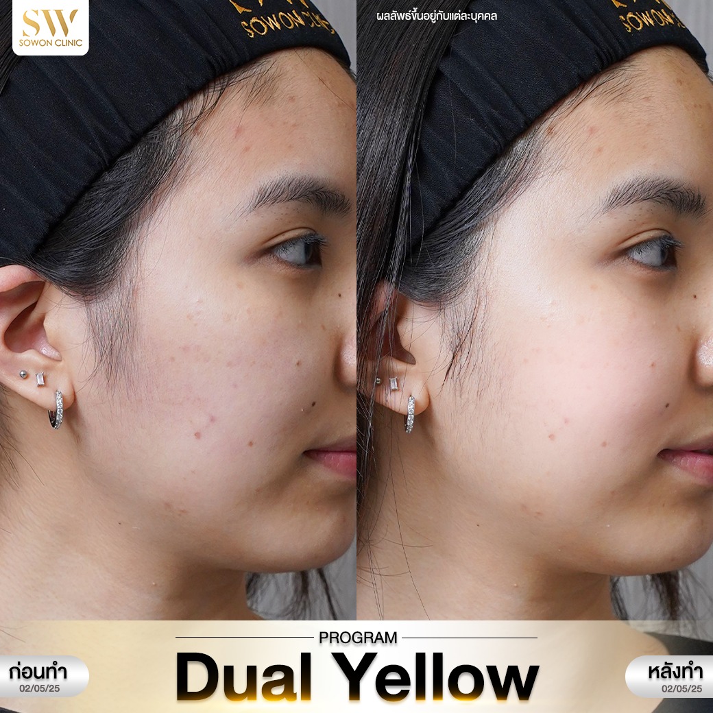 เลเซอร์หน้าใส รีวิว02