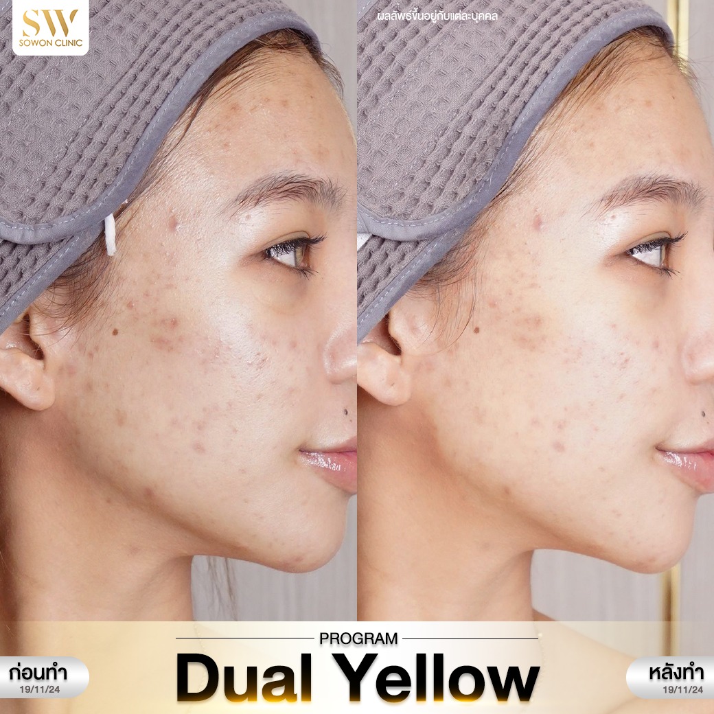 เลเซอร์หน้าใส รีวิว04