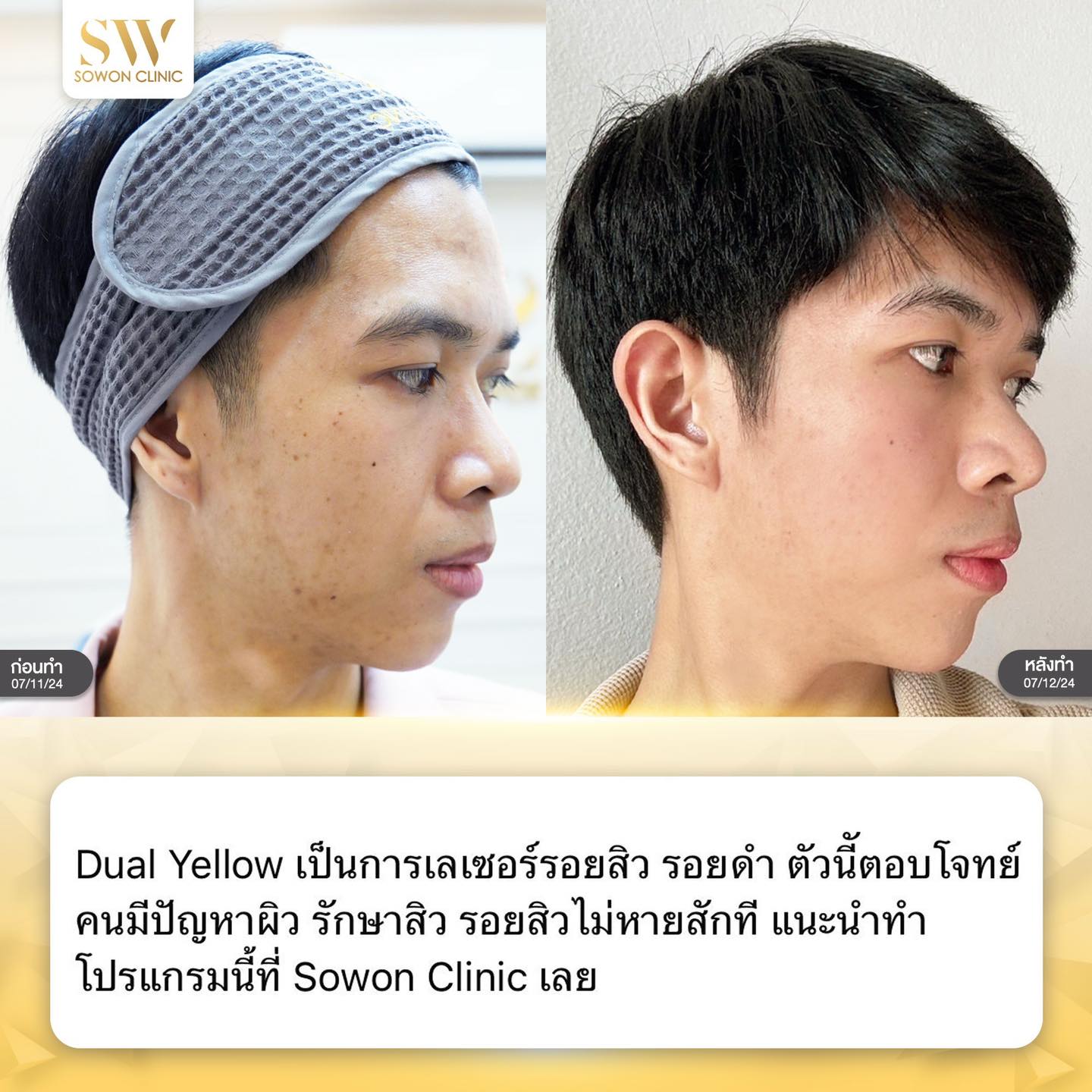 เลเซอร์หน้าใส รีวิว09