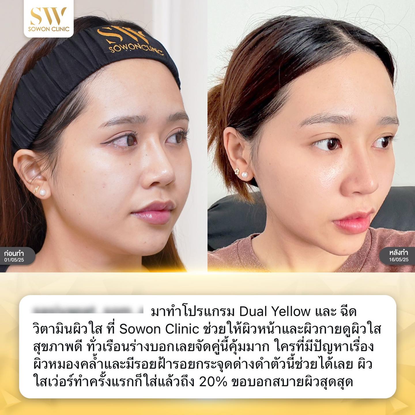 เลเซอร์หน้าใส รีวิว08