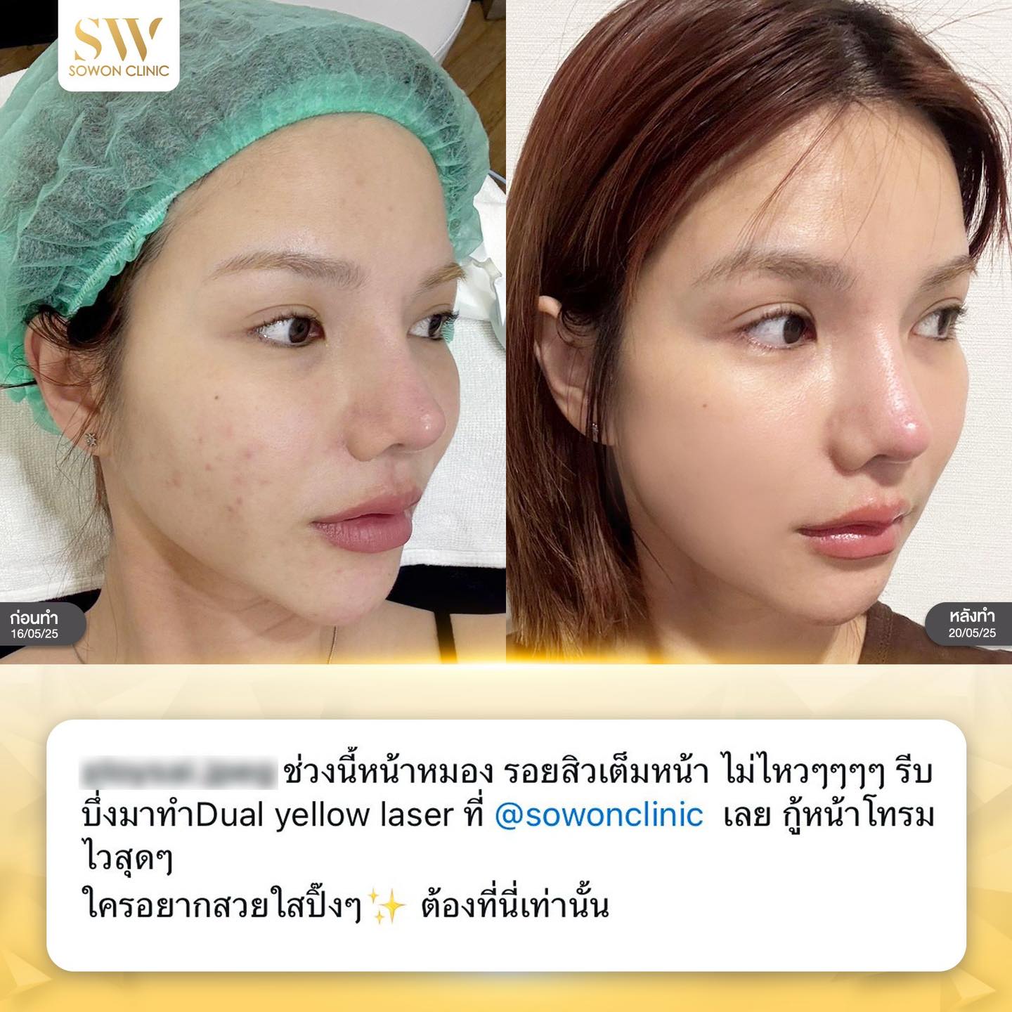 เลเซอร์หน้าใส รีวิว07