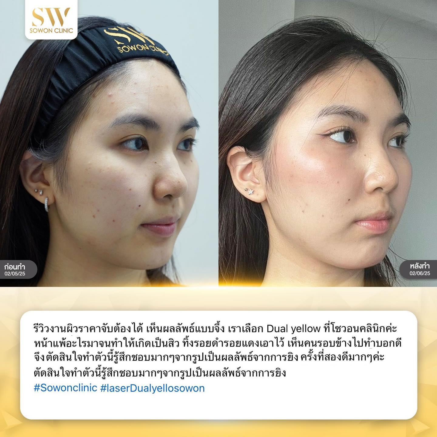 เลเซอร์หน้าใส รีวิว06