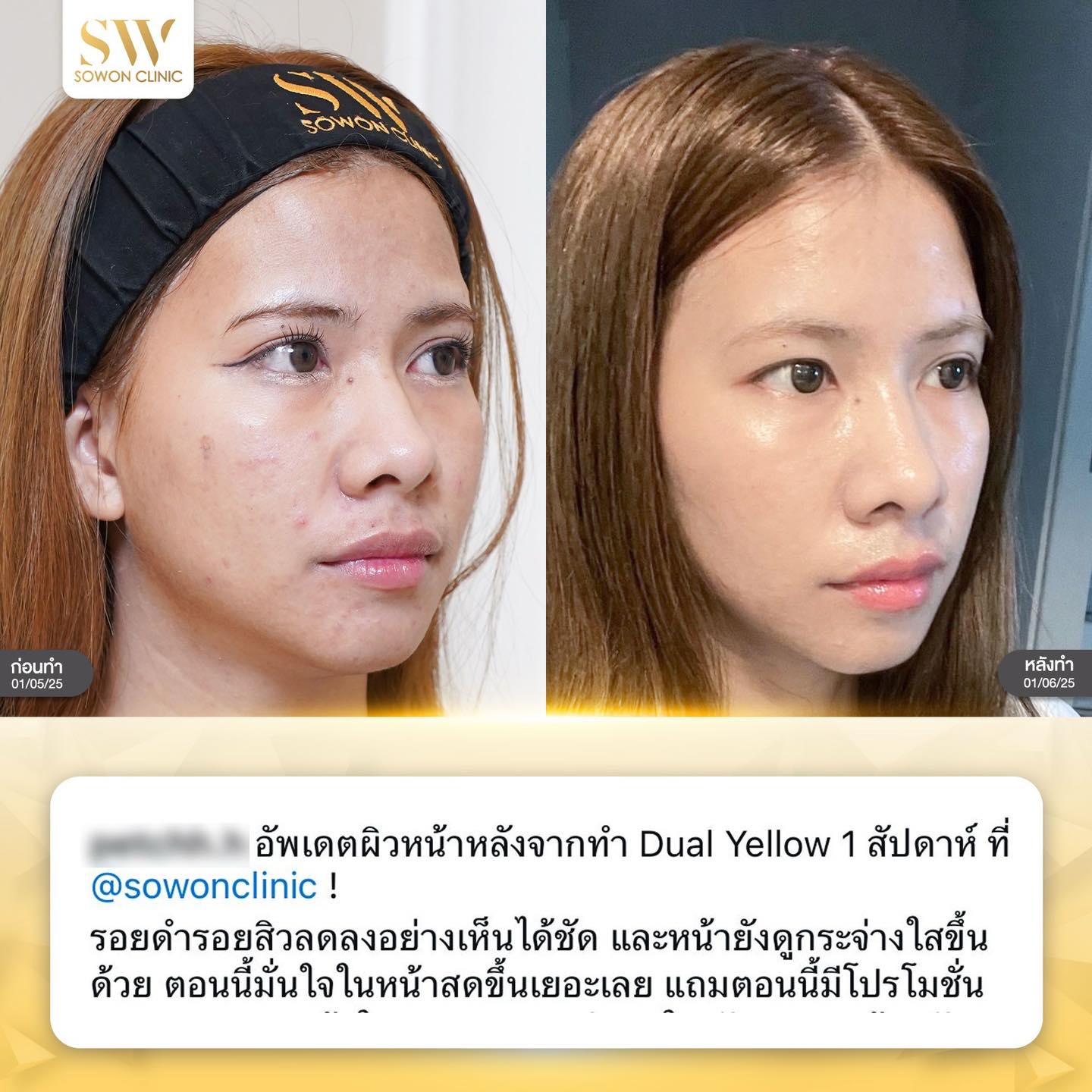 เลเซอร์หน้าใส รีวิว05