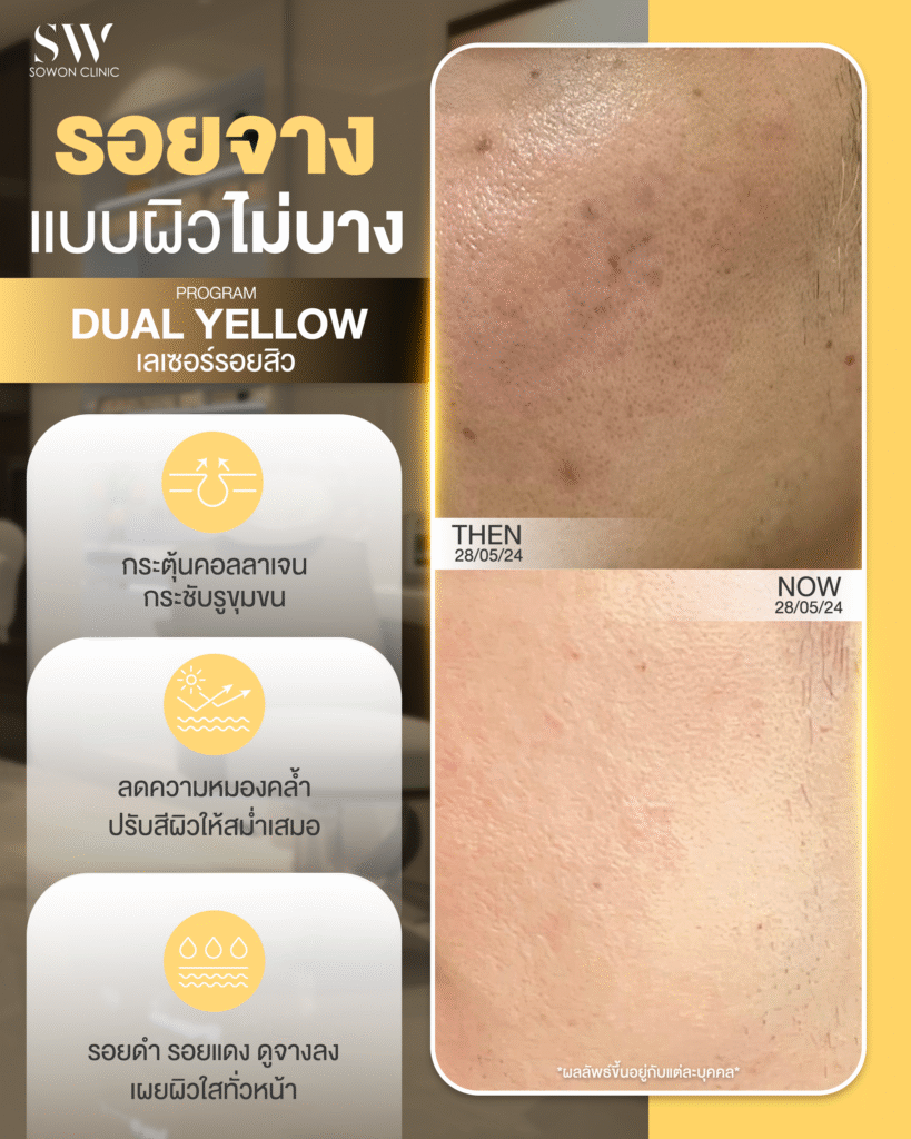 Dual Yellow รอยจาง
