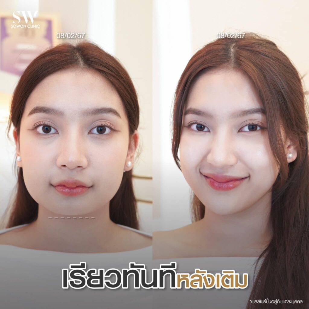 โปรแกรมฉีดสารเติมเต็ม ผลลัพธ์