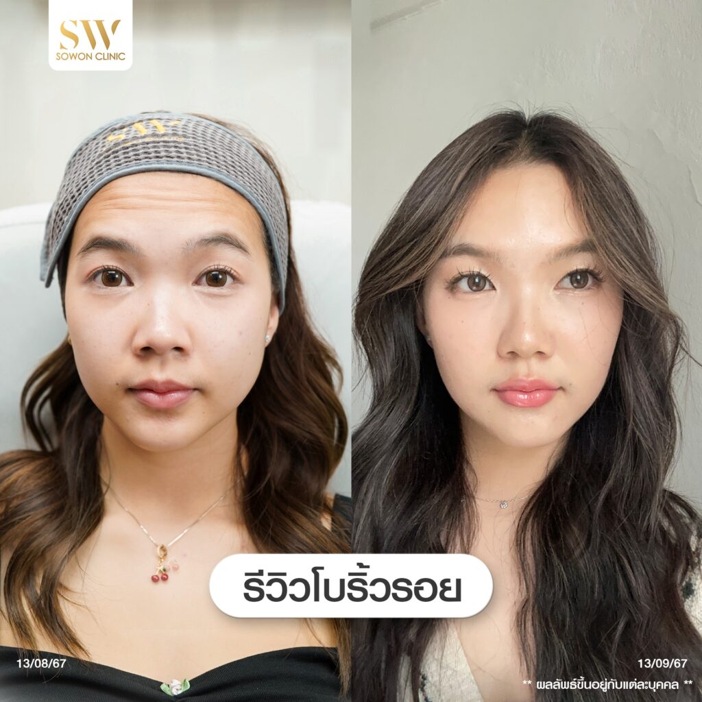 โปรแกรมโบลดริ้วรอย 01