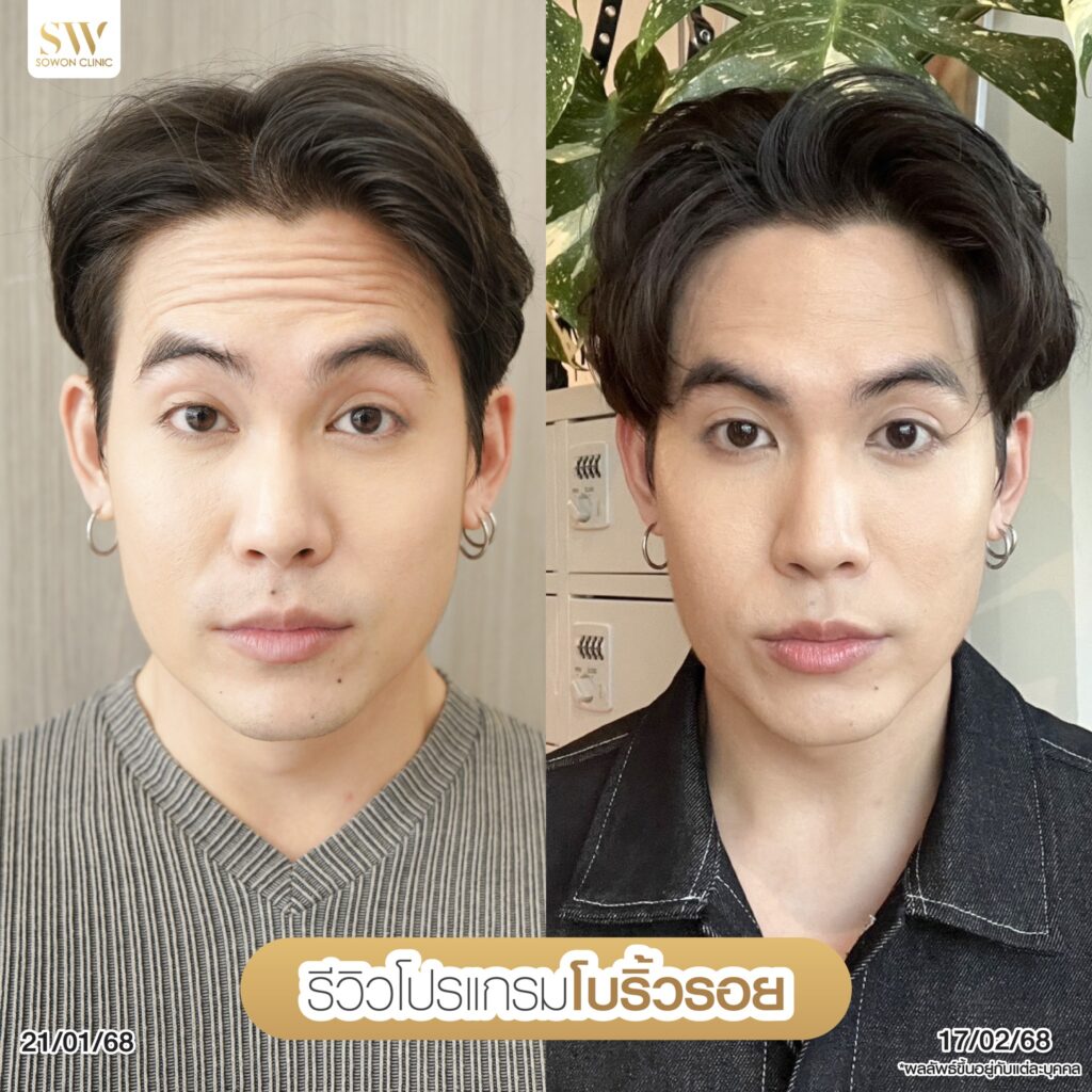 โปรแกรมโบลดริ้วรอย02