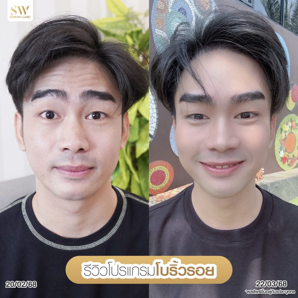 โปรแกรมโบลดริ้วรอย04