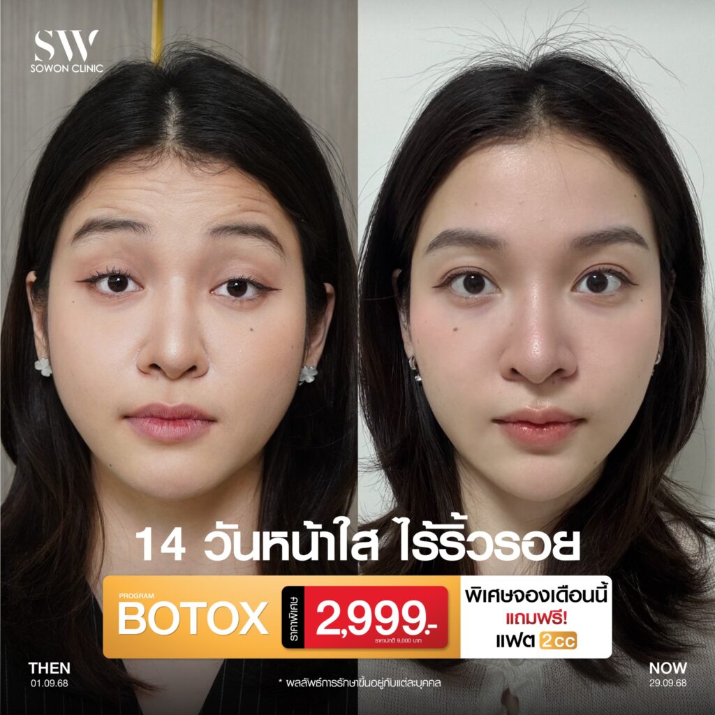 Botox for wrinkles price