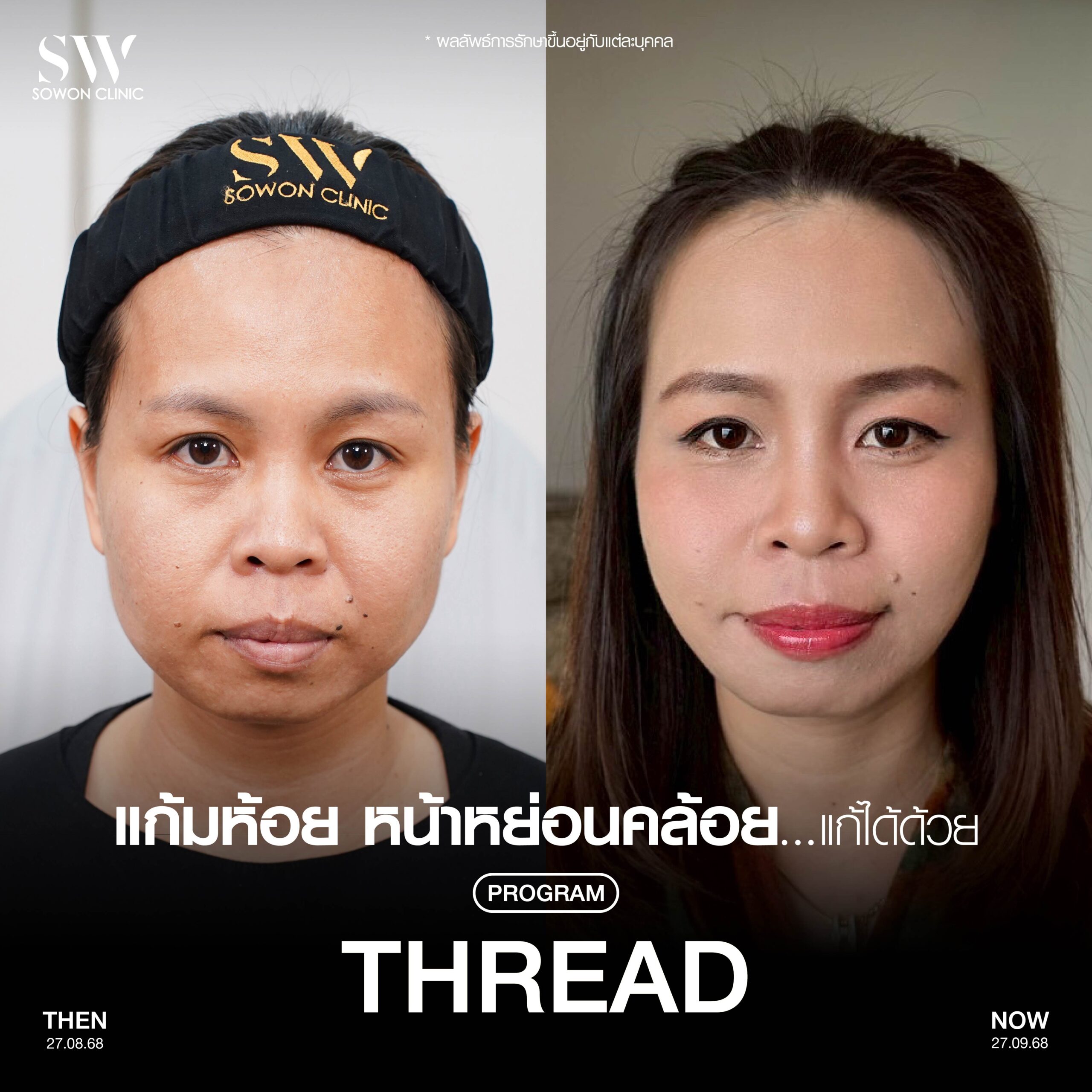Thread lift 05