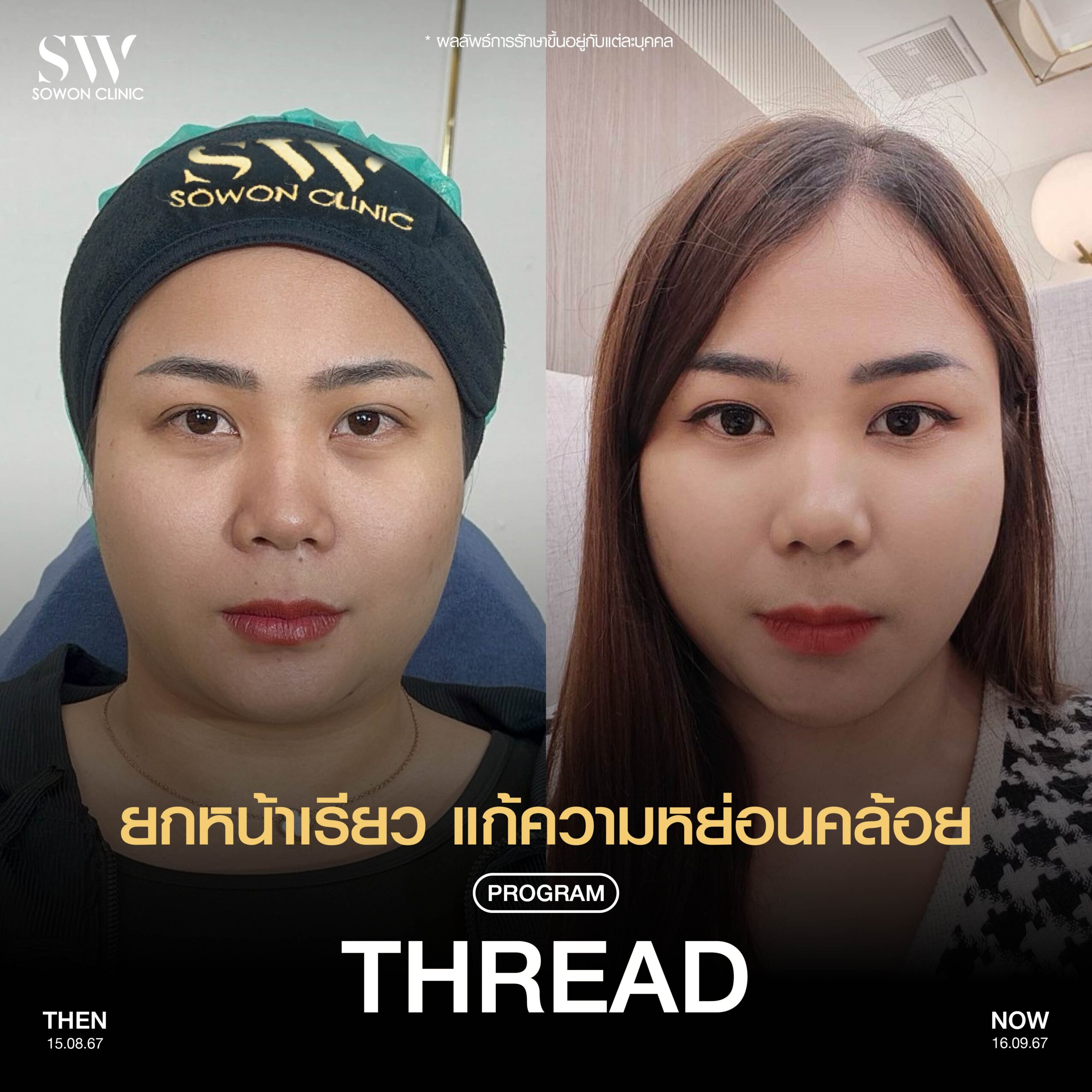 Thread lift 06