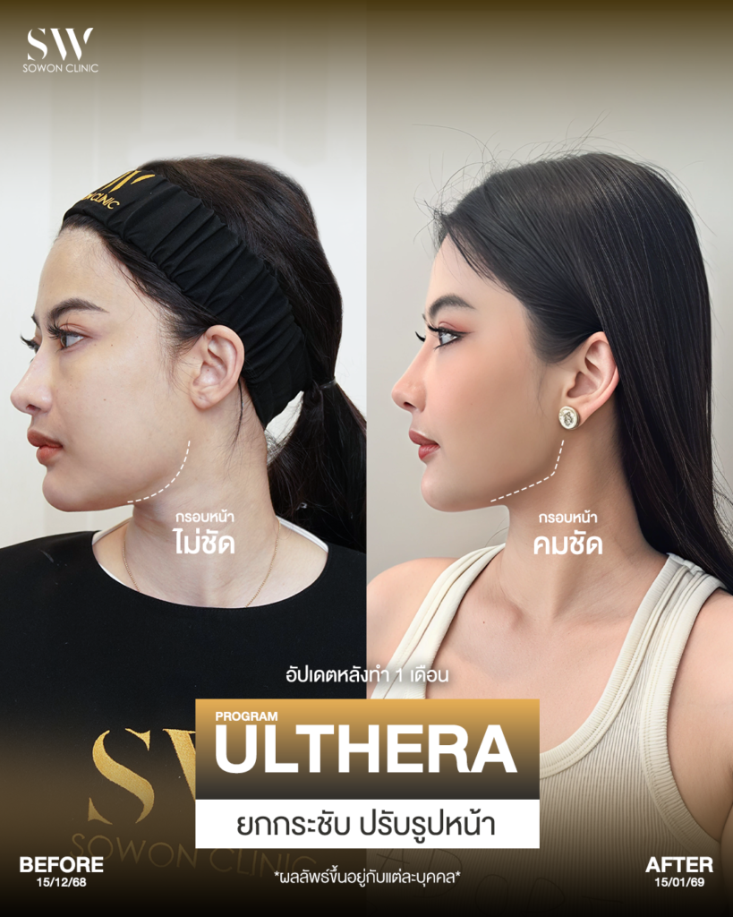Ulthera