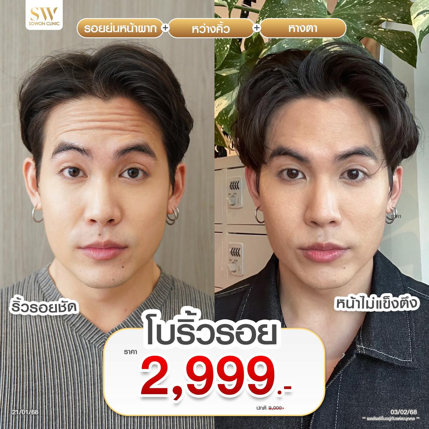 โปรแกรมโบลดริ้วรอย ราคา