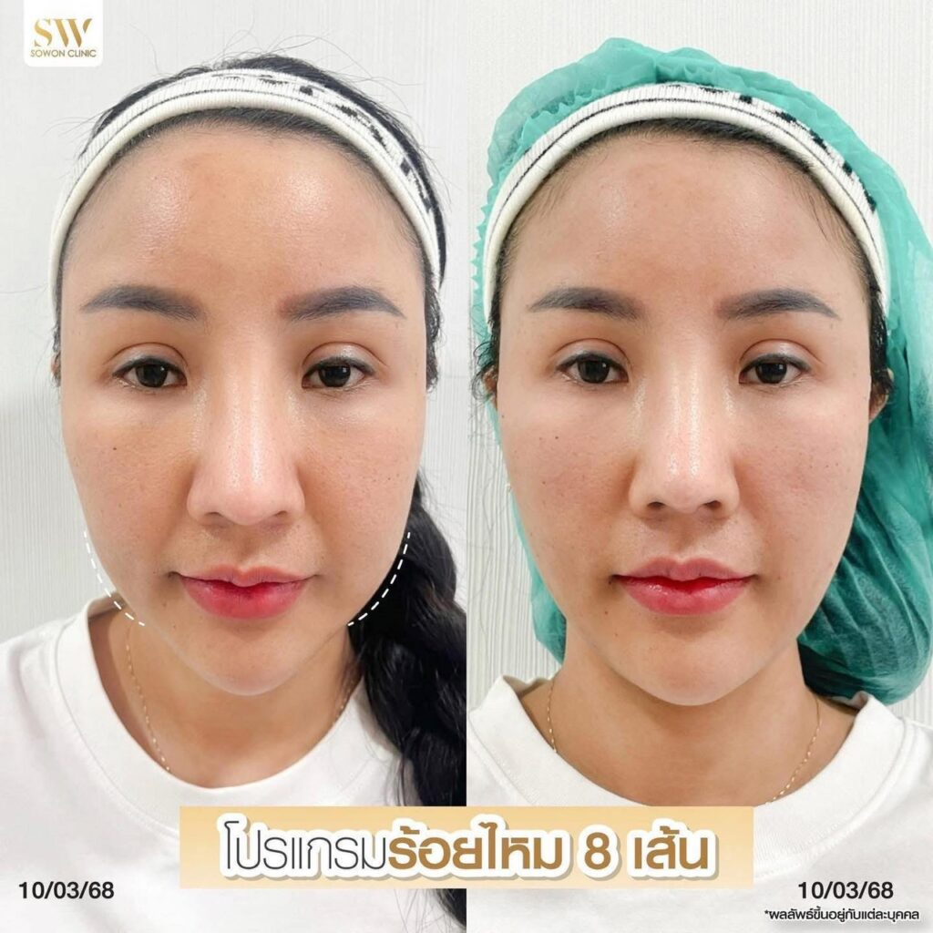 ร้อยไหมหน้าเรียว 3