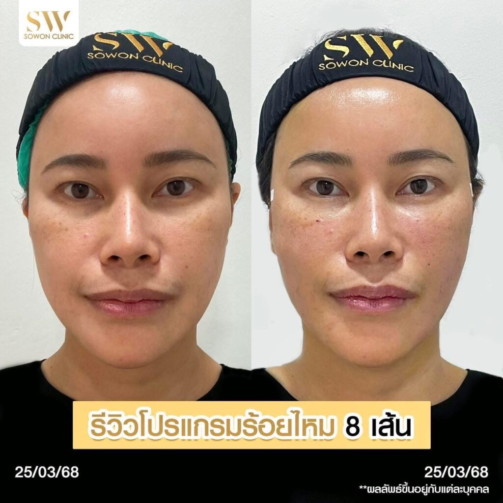 ร้อยไหมหน้าเรียว03
