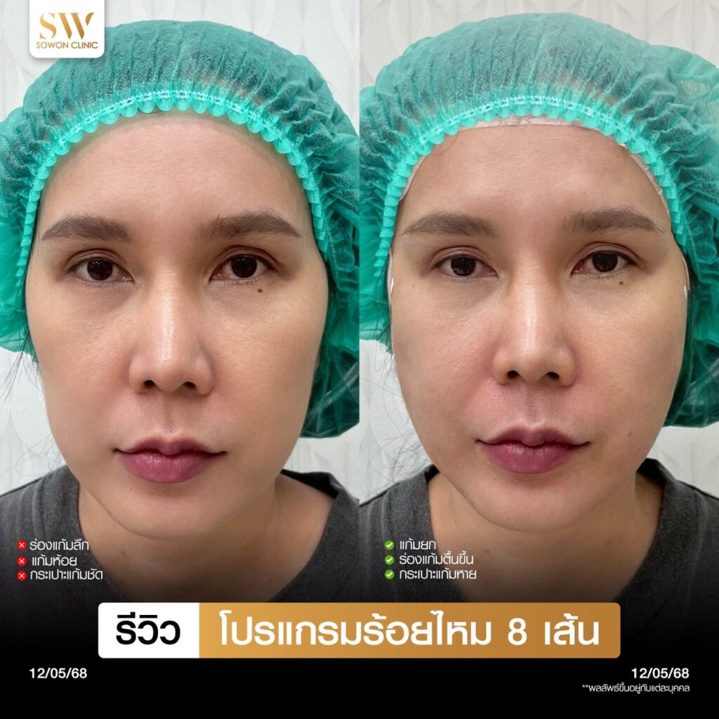 ร้อยไหมหน้าเรียว05