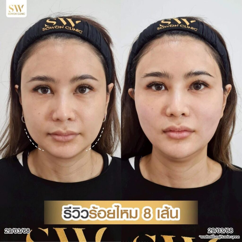 ร้อยไหมหน้าเรียว04