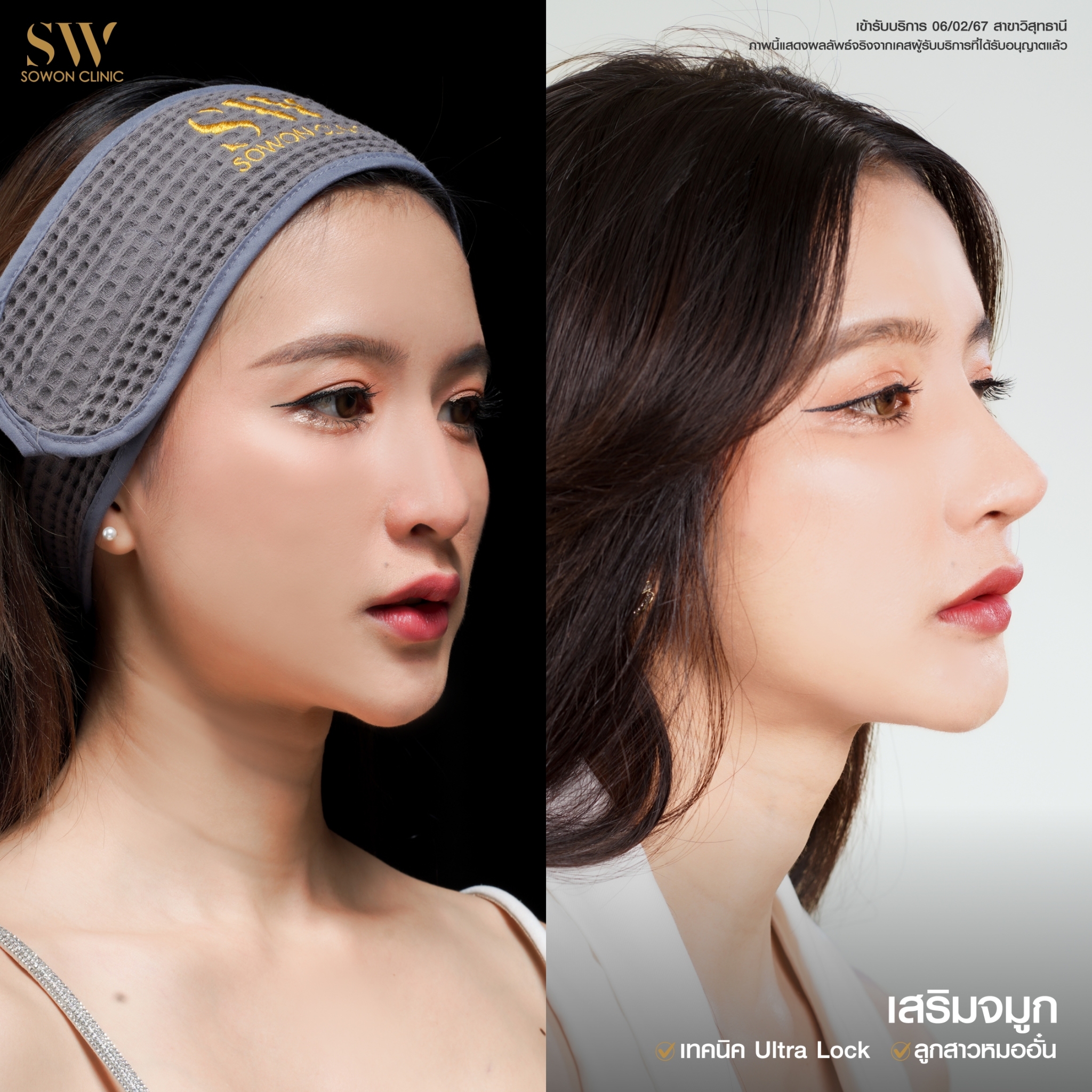 โปรโมชั่นพิเศษ Sowon Clinic รีวืวลูกสาวโซวอน01