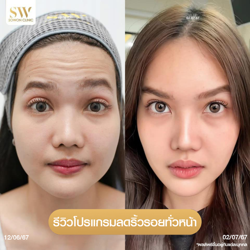 โปรโมชั่นร้อยไหมมิ้นท์โปรแกรมลดริ้วรอย รีวิว004