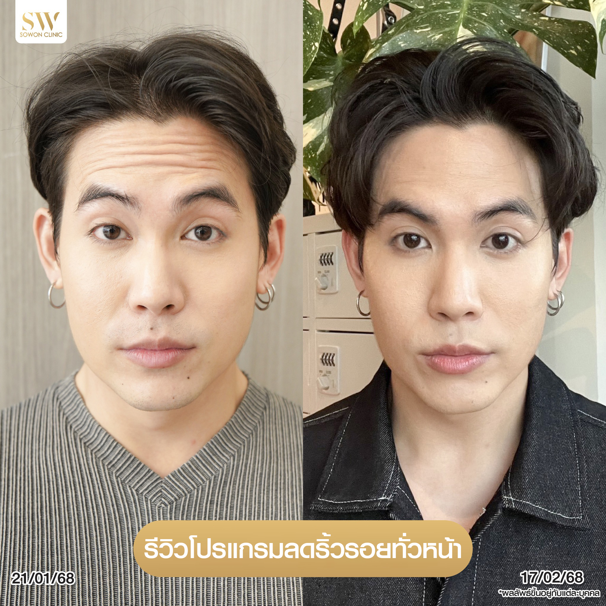 โปรโมชั่นร้อยไหมมิ้นท์โปรแกรมลดริ้วรอย รีวิว003