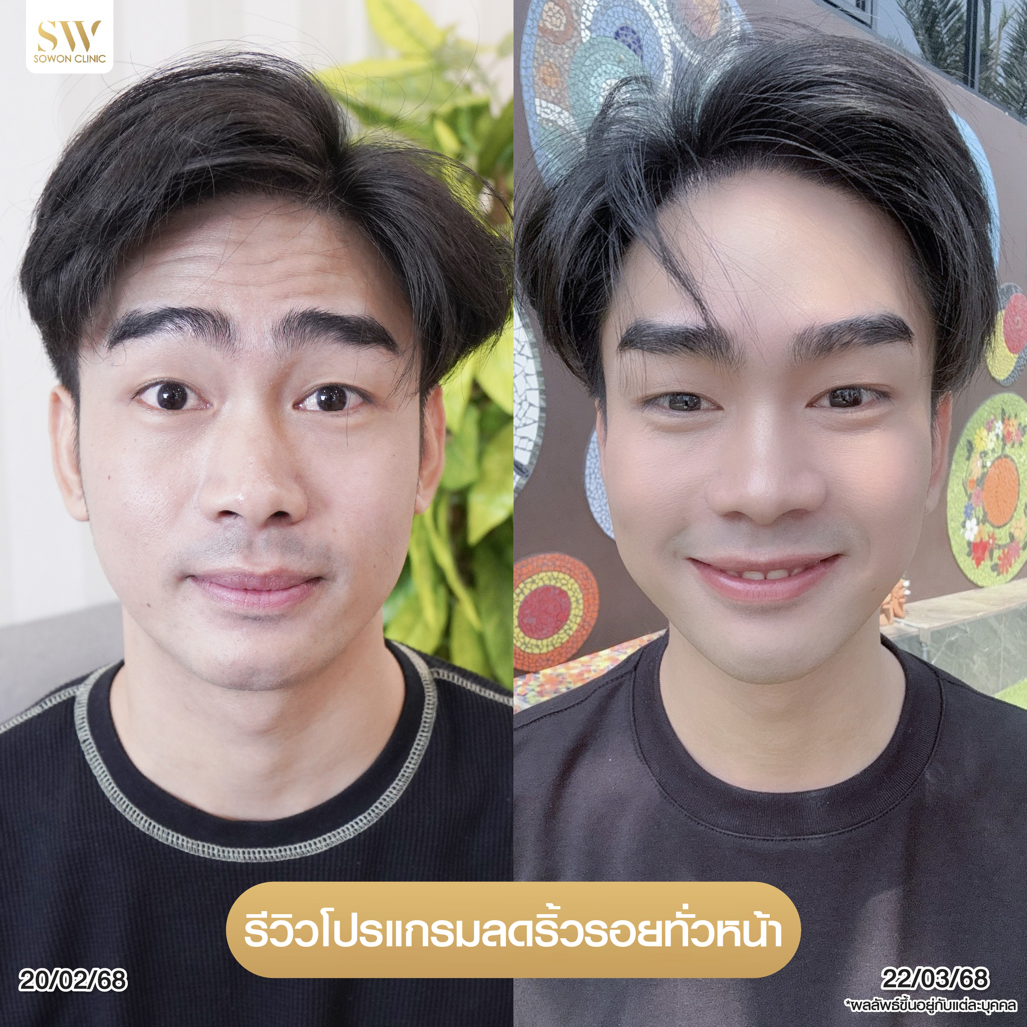 โปรโมชั่นร้อยไหมมิ้นท์โปรแกรมลดริ้วรอย รีวิว001