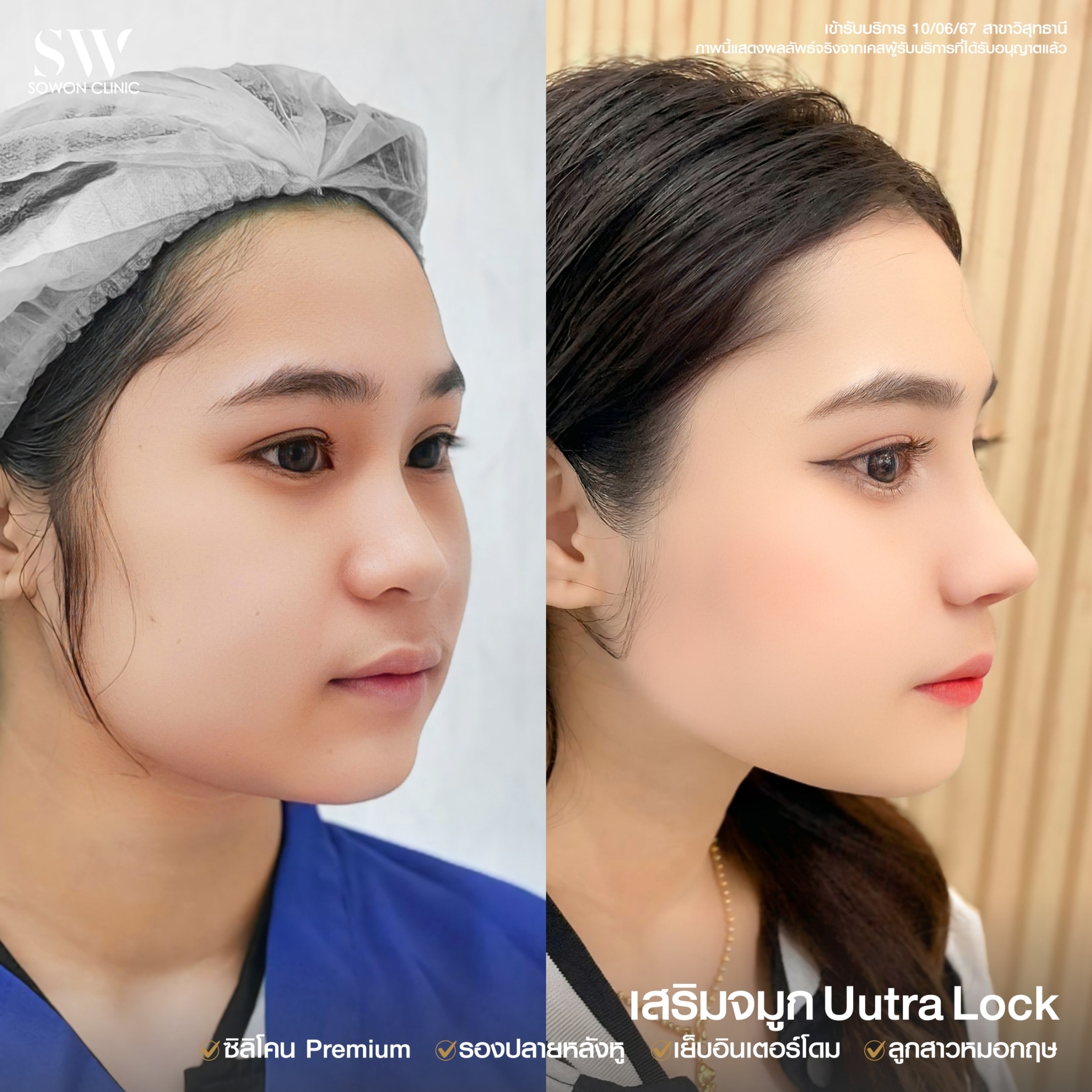 ทรงจมูกสโลปหวาน012