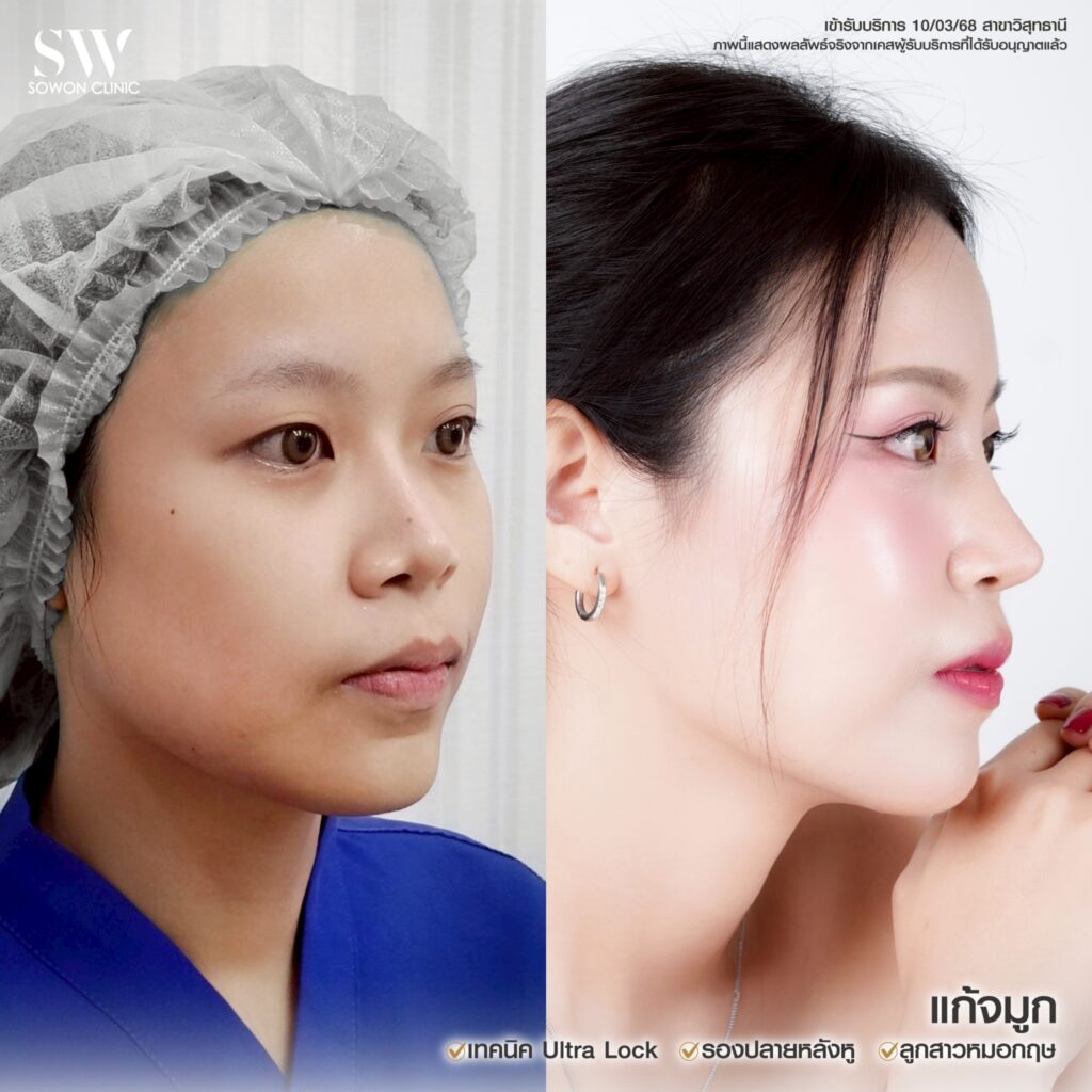 เสริมจมูกครั้งแรกที่ไหนดี ทรงจมูกสโลปหวาน03