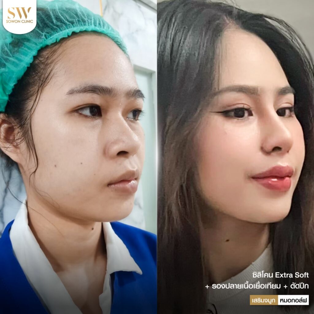 ตัดปีกจมูก รีวิว10