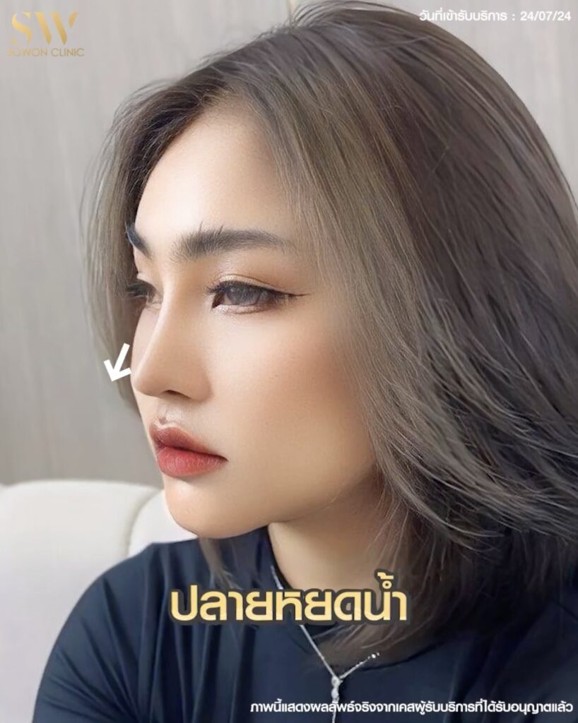 เสริมจมูกสโลปหวาน ทรงสโลปปลายหยดน้ำ