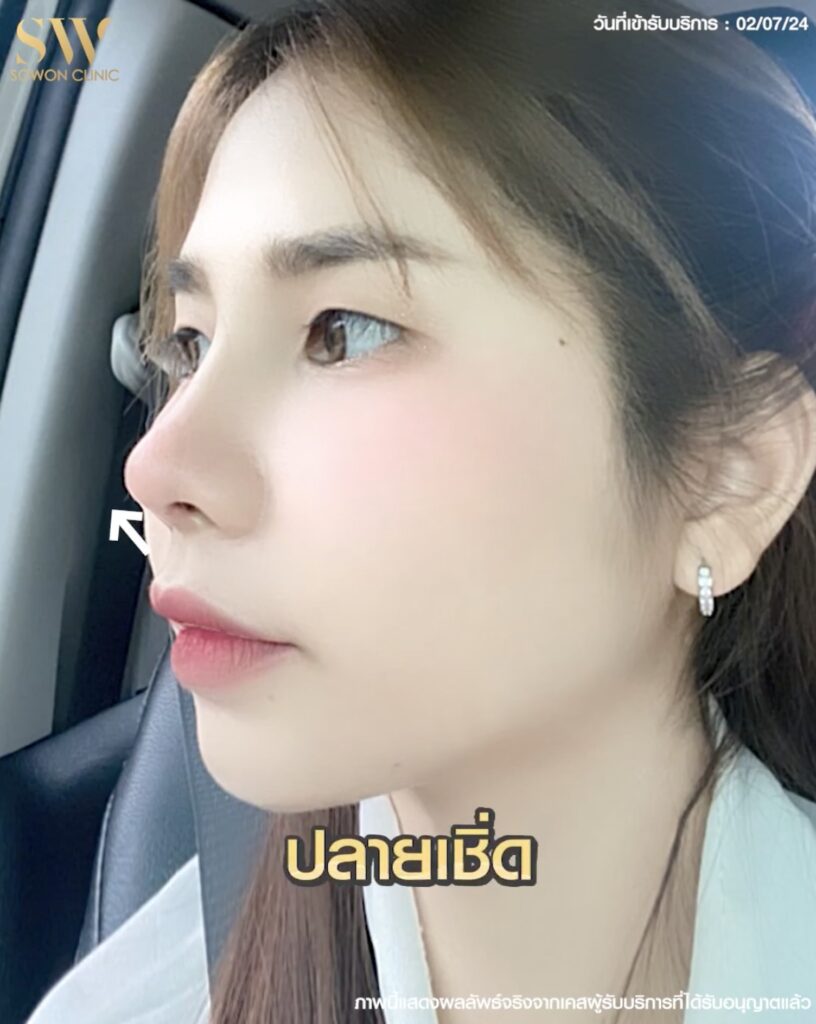 เสริมจมูกสโลปหวาน ทรงสโลปปลายเชิด