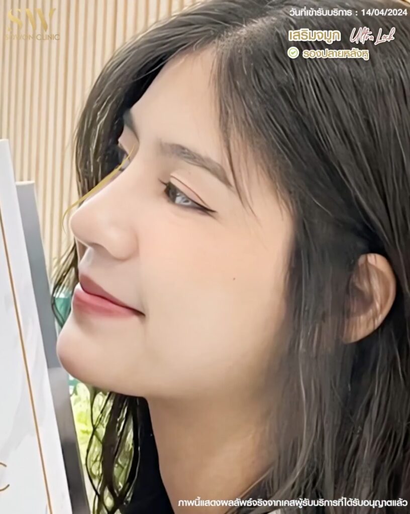 เสริมจมูกสโลปหวาน ทรงสโลปหวาน