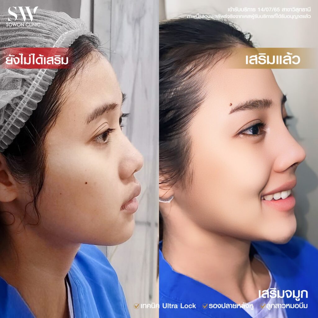 เสริมจมูกสโลปหวาน รีวิวคุณไอซ์02