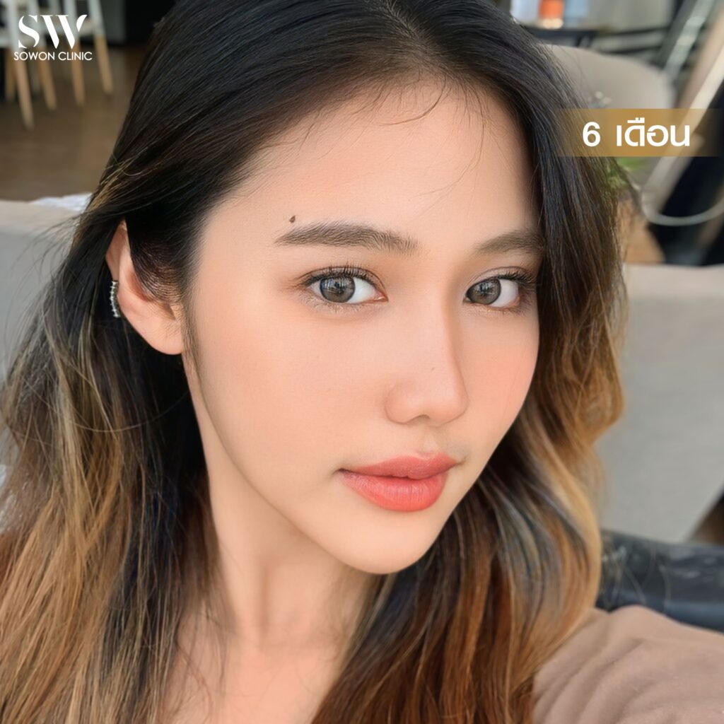 เสริมจมูกสโลปหวาน รีวิวคุณไอซ์03