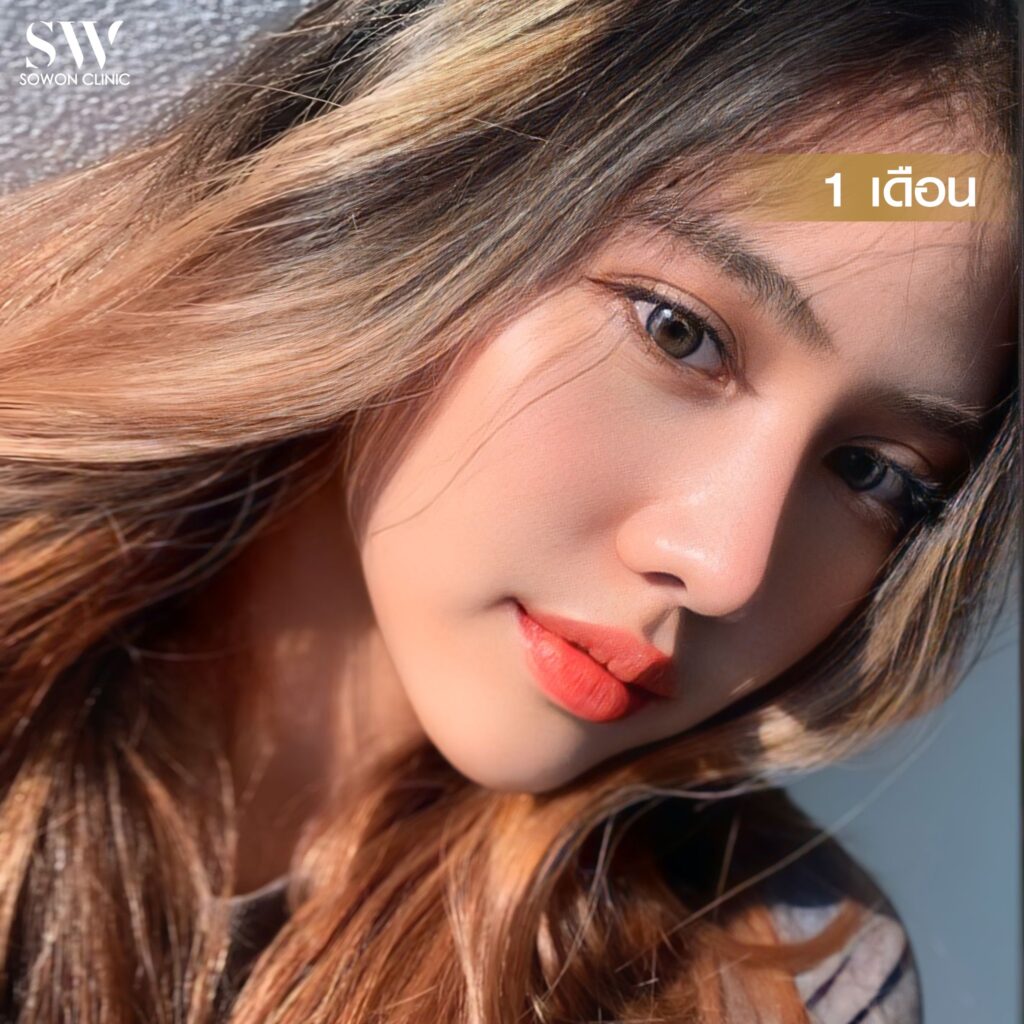 เสริมจมูกสโลปหวาน รีวิวคุณไอซ์05