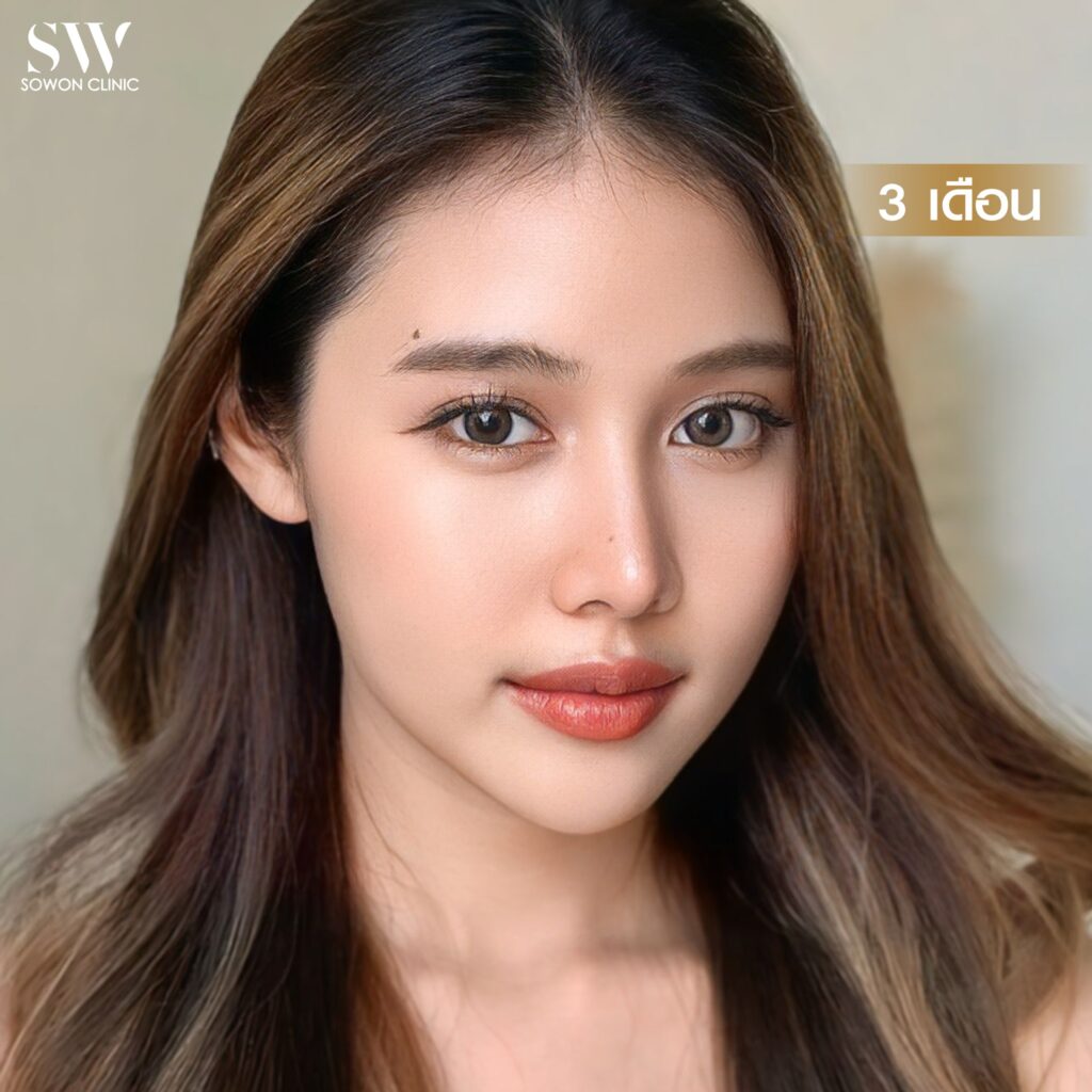 เสริมจมูกสโลปหวาน รีวิวคุณไอซ์07
