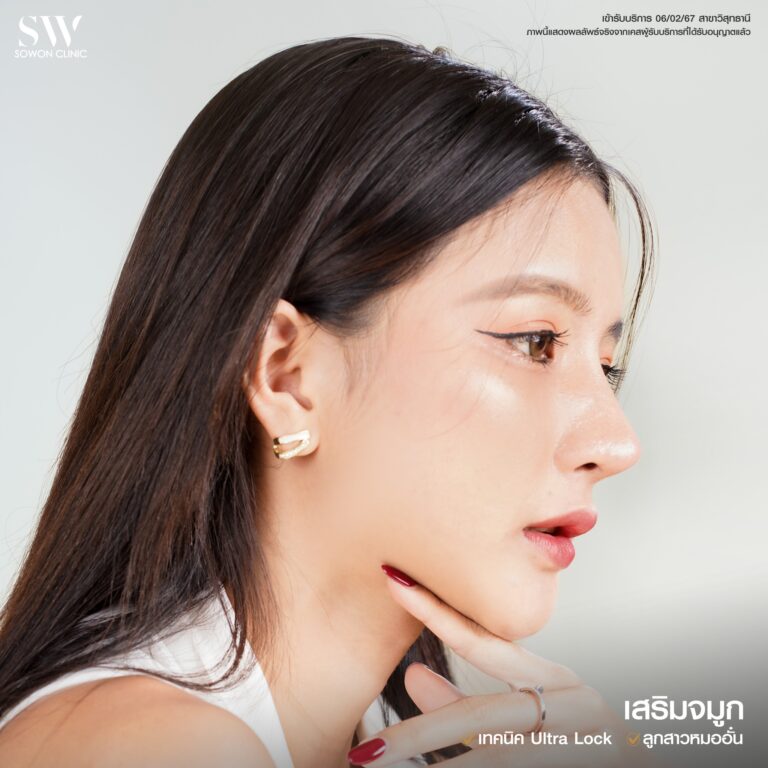 รีวิวเสริมจมูก01