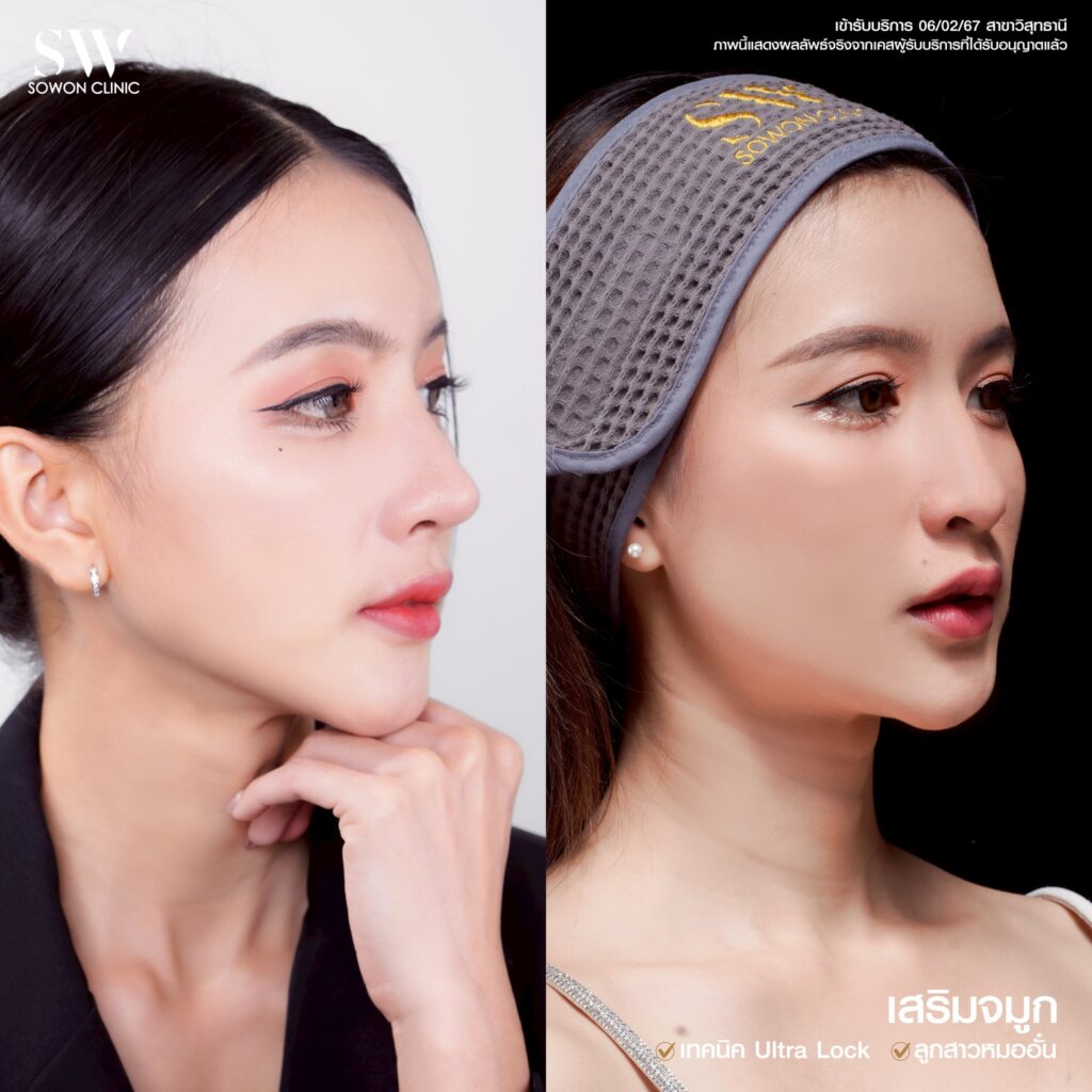 รีวิวเสริมจมูก08