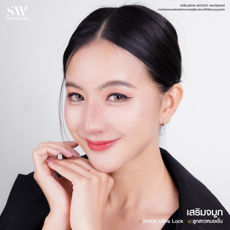 รีวิวเสริมจมูก07