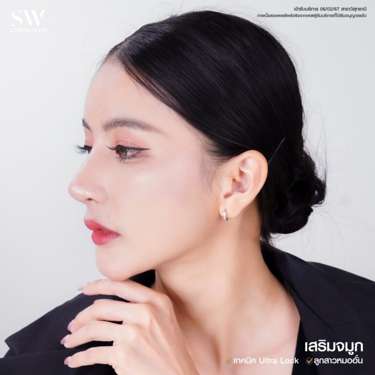 รีวิวเสริมจมูก05