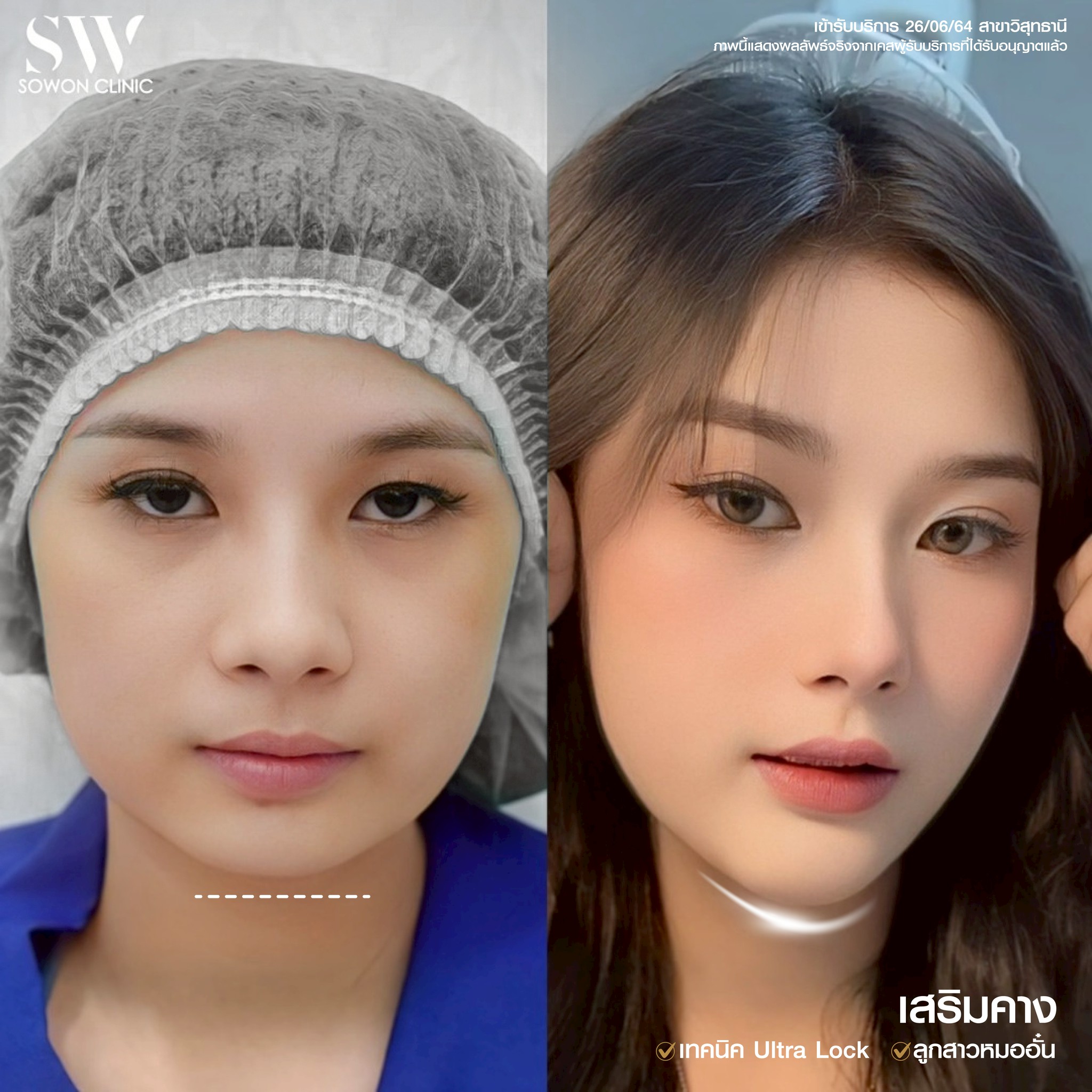 เสริมคาง 04