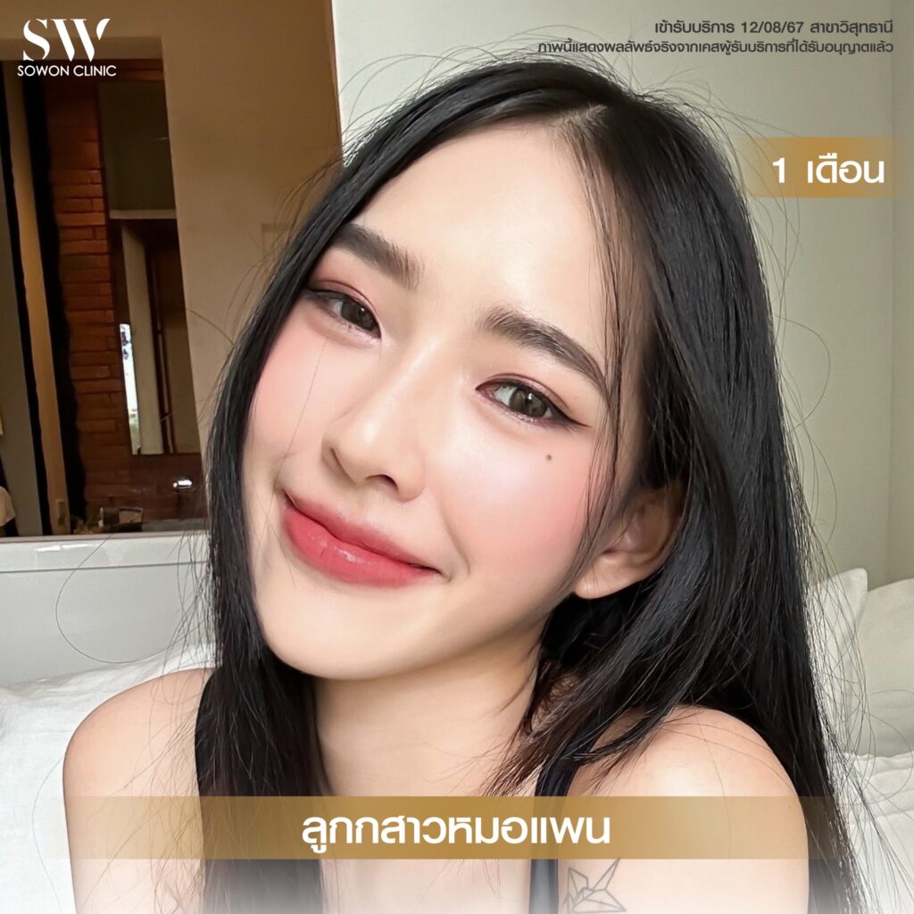 เสริมคาง คุณเฟิร์น04