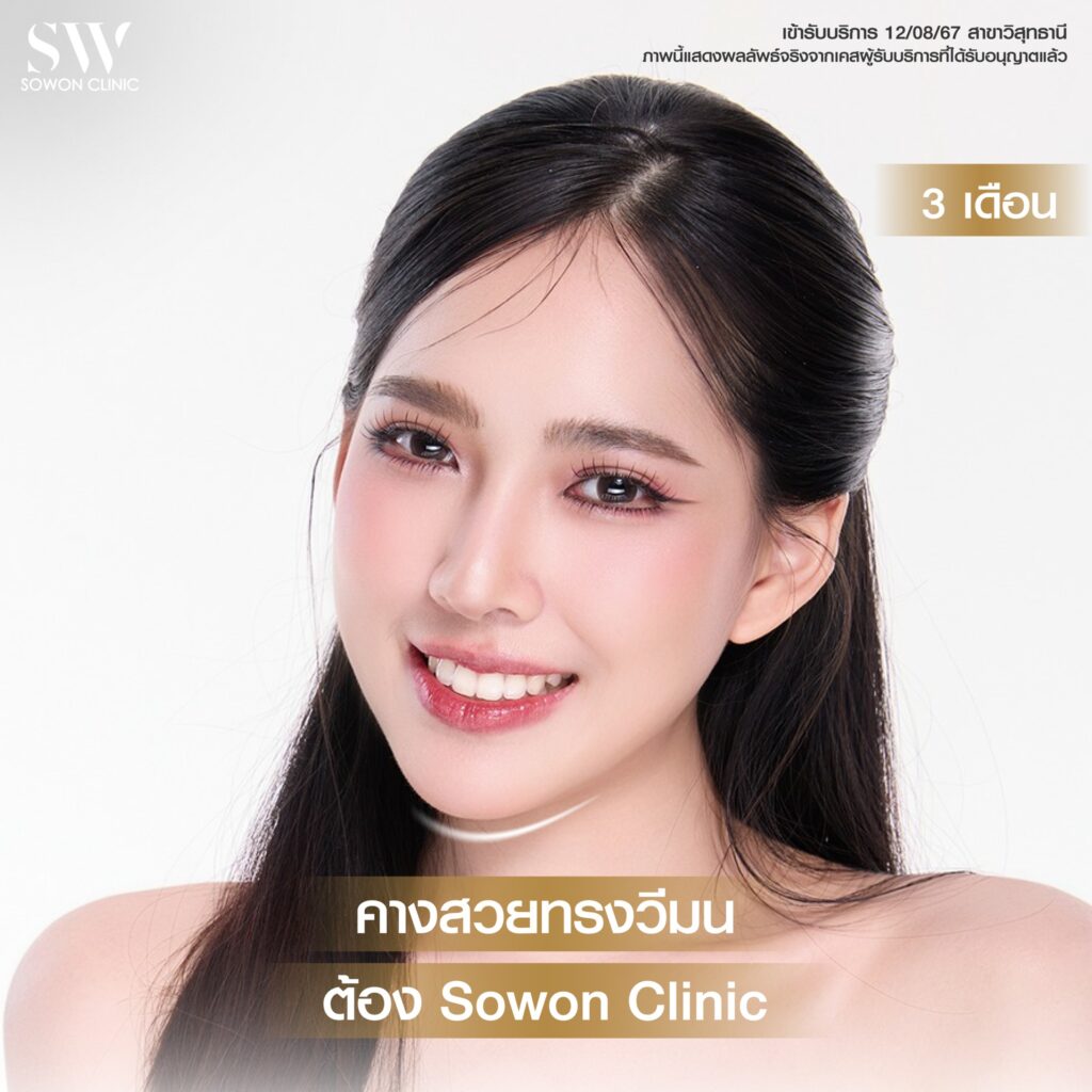 เสริมคาง คุณเฟิร์น05