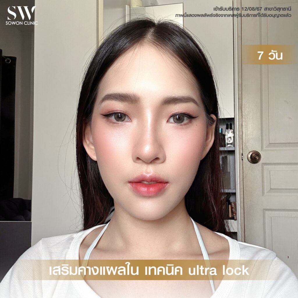 เสริมคาง คุณเฟิร์น03